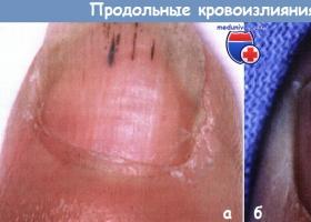 Подногтевая гематома или синяк под ногтем: лечение и причины Под ногтем синяк что делать