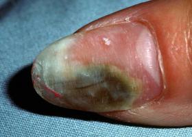 Плесень на ногтях: причины появления и лечение